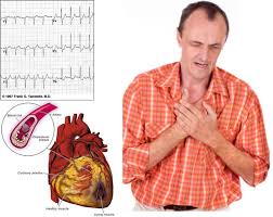 Infarto