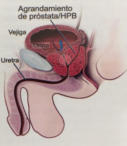 PROSTATA2