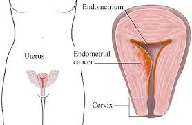 ENDOMETRIO