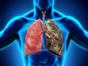 Cancer_pulmon