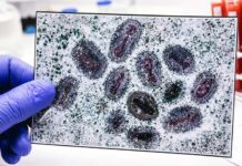 CALIFORNIA detecta primera INFECCIÓN autóctona en EU de una variante SEVERA de MPOX